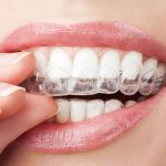 Aftercare Tips When Getting Dental Braces